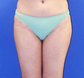 30代女性の脂肪吸引 After 症例写真