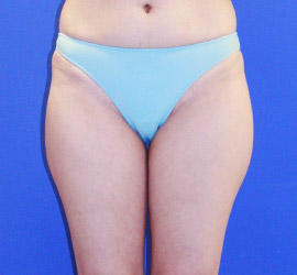 30代女性の脂肪吸引 Before 症例写真