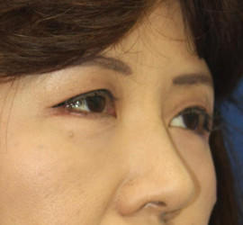 50代女性の下まぶたのたるみ取り After 症例写真