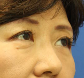 50代女性の下まぶたのたるみ取り Before 症例写真