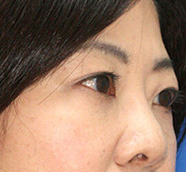 50代女性の目の下の脱脂  After 症例写真