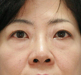 50代女性の目の下のクマ治療 Before 症例写真