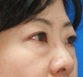 50代女性の目の下の脱脂  Before 症例写真