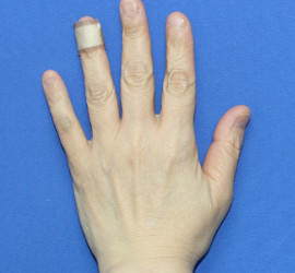 50代女性のリジュランHB After 症例写真