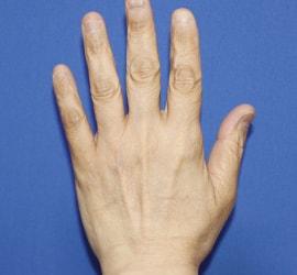 50代女性のリジュランHB Before 症例写真