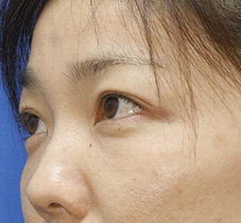 40代女性の目の下の脱脂  After 症例写真