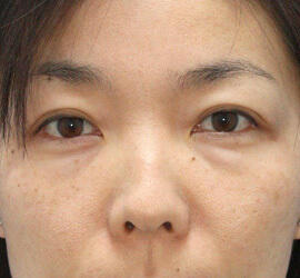 40代女性の目の下のクマ治療 Before 症例写真