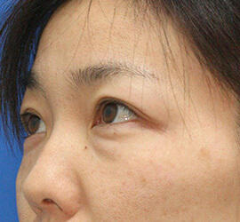 40代女性の目の下の脱脂  Before 症例写真