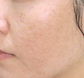 30代女性のアンコア（ブリッジセラピー） After 症例写真