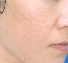 30代女性のアンコア（ブリッジセラピー） After 症例写真