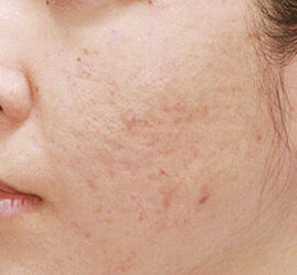 30代女性のアンコア（ブリッジセラピー） Before 症例写真