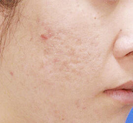 30代女性のアンコア（ブリッジセラピー） Before 症例写真