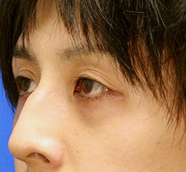 30代男性の下まぶたのたるみ取り After 症例写真