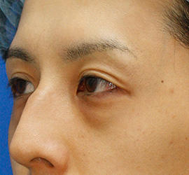 30代男性の下まぶたのたるみ取り Before 症例写真