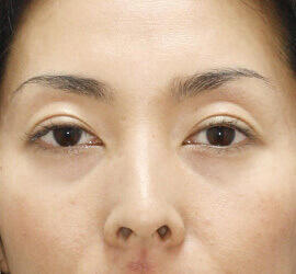 30代女性の二重埋没法 After 症例写真