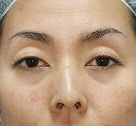 30代女性の二重埋没法 Before 症例写真