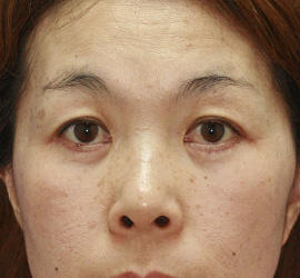 40代女性の下まぶたのたるみ取り After 症例写真