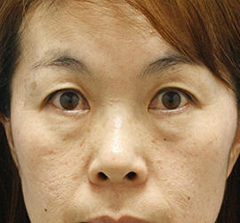 40代女性の下まぶたのたるみ取り Before 症例写真
