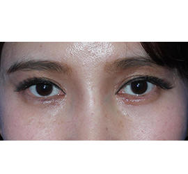 20代女性のシワ・たるみ After 症例写真