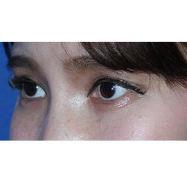 20代女性のヒアルロン酸注射  After 症例写真