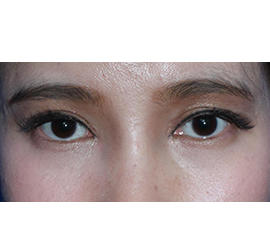 20代女性のシワ・たるみ Before 症例写真