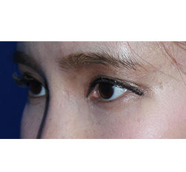 20代女性のヒアルロン酸注射  Before 症例写真