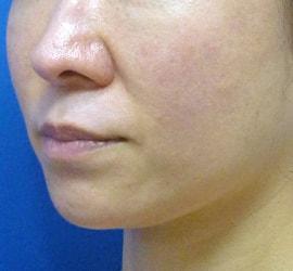 40代女性のリジュランHB After 症例写真