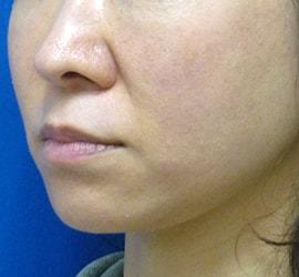 40代女性のリジュランHB Before 症例写真