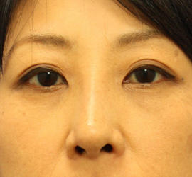 40代女性の目の下の脱脂 After 症例写真
