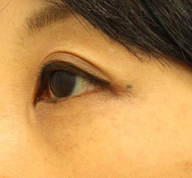 40代女性の目の下の脱脂  After 症例写真