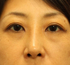 40代女性の目の下の脱脂 Before 症例写真