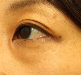 40代女性の目の下の脱脂  Before 症例写真