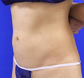 40代女性の脂肪吸引 After 症例写真