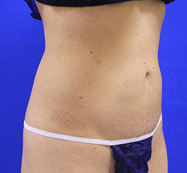 40代女性の脂肪吸引 After 症例写真