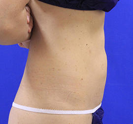 40代女性の脂肪吸引 After 症例写真