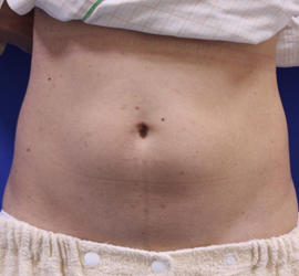 40代女性の脂肪吸引 Before 症例写真