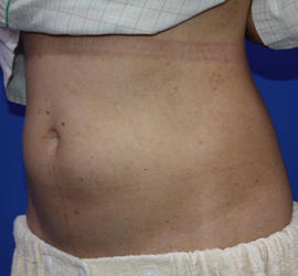 40代女性の脂肪吸引 Before 症例写真