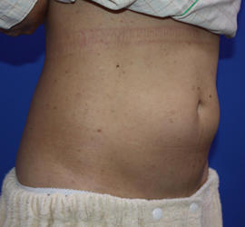 40代女性の脂肪吸引 Before 症例写真