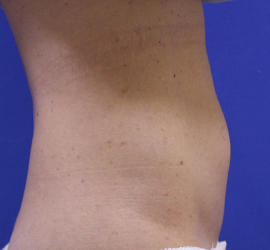 40代女性の脂肪吸引 Before 症例写真