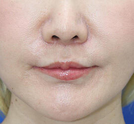 40代女性の唇・口元の整形 After 症例写真