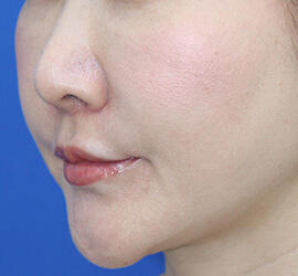 40代女性の人中短縮(リップリフト) After 症例写真