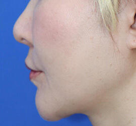 40代女性の人中短縮(リップリフト) After 症例写真