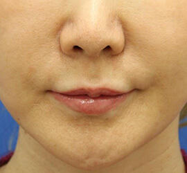 40代女性の唇・口元の整形 Before 症例写真