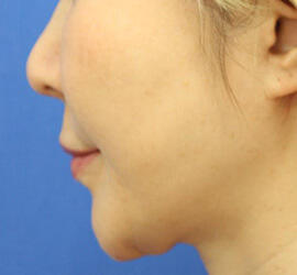 40代女性の人中短縮(リップリフト) Before 症例写真