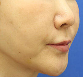 40代女性の人中短縮(リップリフト) Before 症例写真