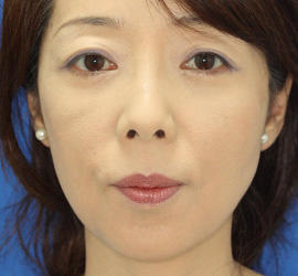 40代女性の下まぶたのたるみ取り After 症例写真