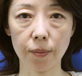 40代女性の下まぶたのたるみ取り Before 症例写真