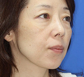 40代女性の下まぶたのたるみ取り Before 症例写真