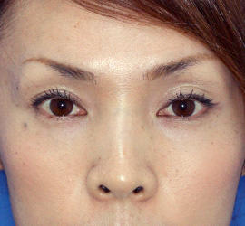 30代女性の目の下のクマ治療 After 症例写真