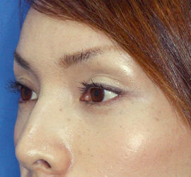 30代女性の目の下の脱脂  After 症例写真